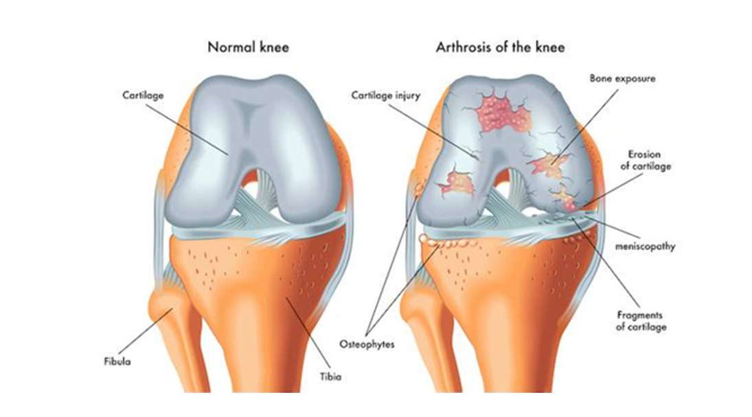 آرتروز چیست