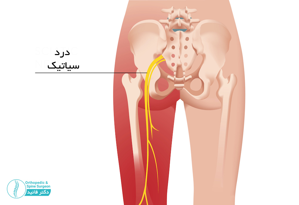 درد سیاتیک