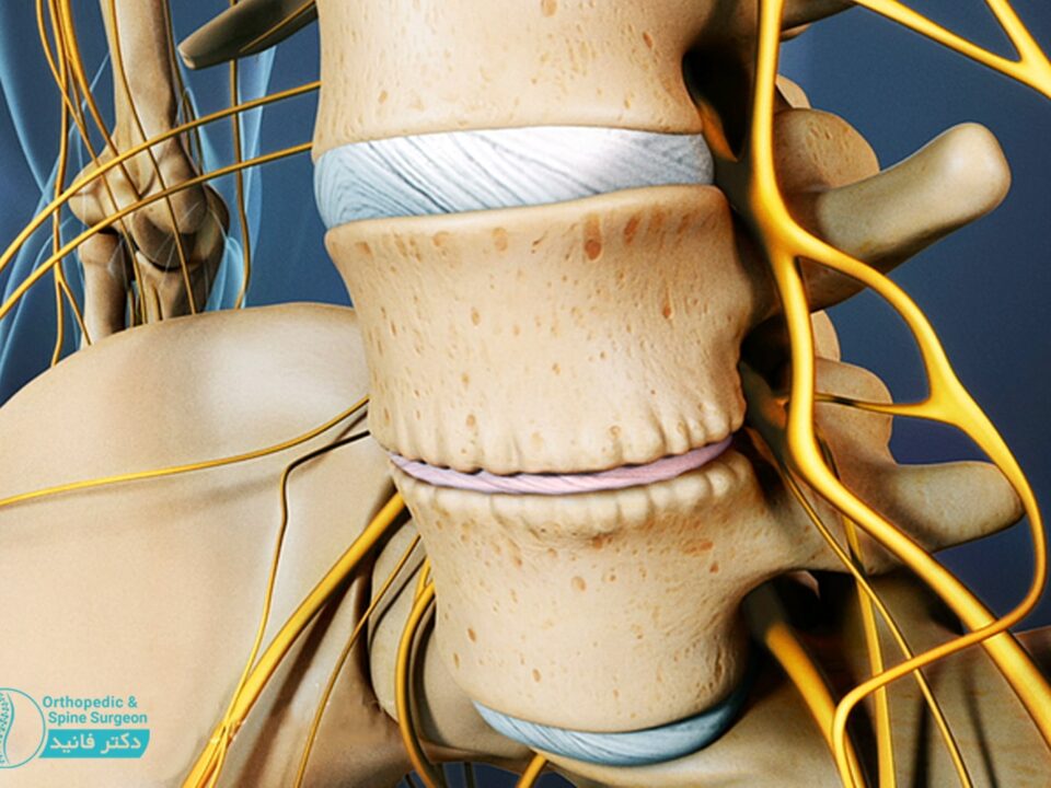 تنگی کانال نخاعی در ستون فقرات کمری