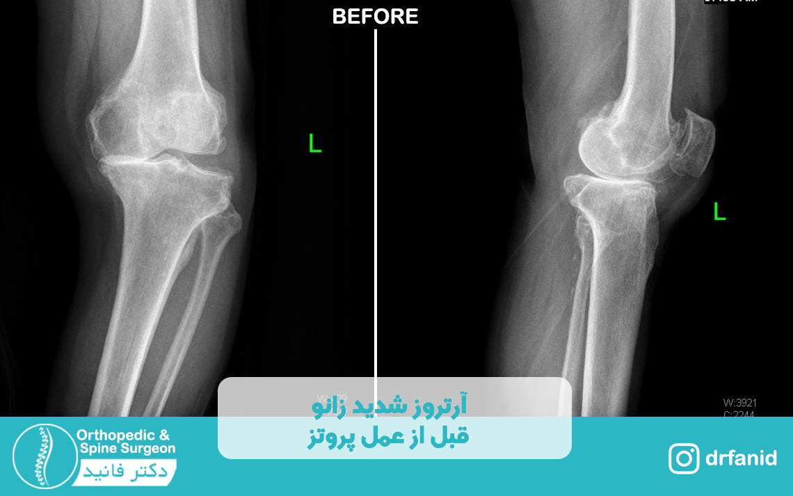 پروتز زانو قبل از عمل