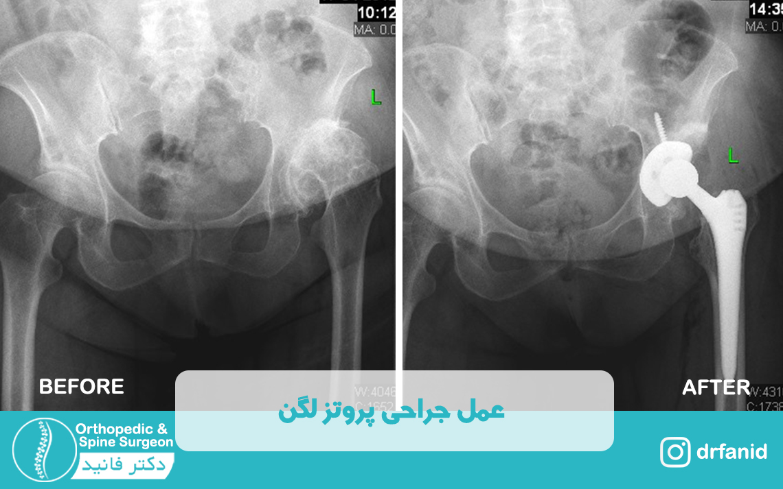 عمل جراحی پروتز لگن