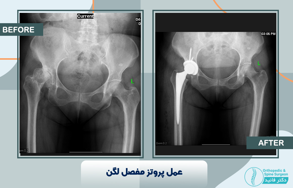 خانم 50 ساله با آرتروز شدید مفصل لگن راست