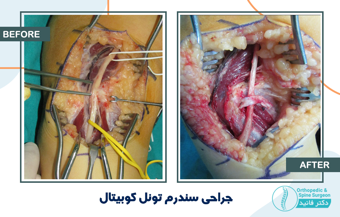 جراحی سندرم تونل کوبیتال