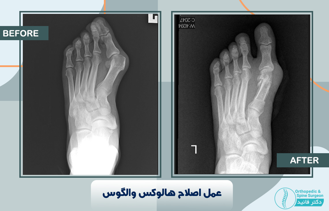 عمل اصلاح هالوکس والگوس 1