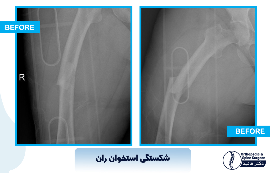 شکستگی اتخوان ران 2