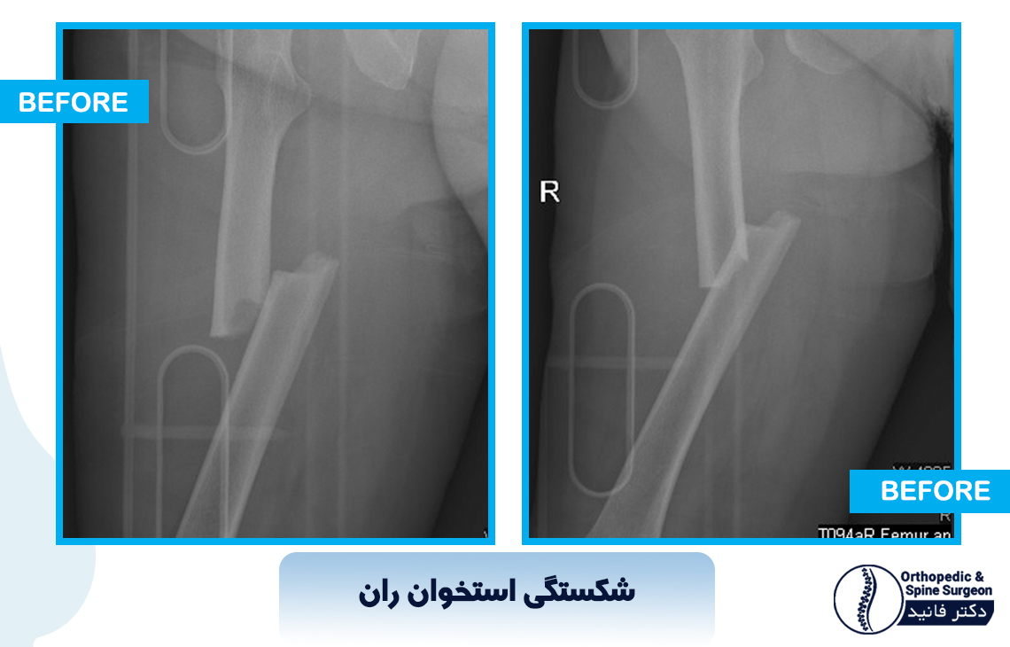 شکستگی استخوان ران 1