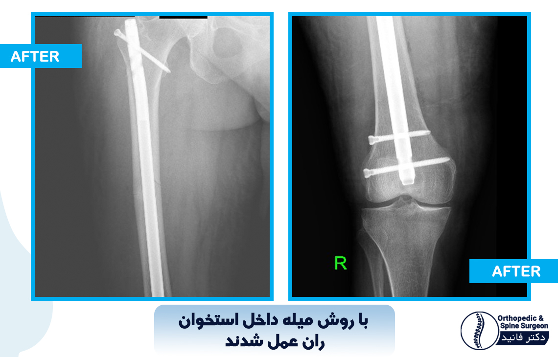 شکستگی مفصل ران 2