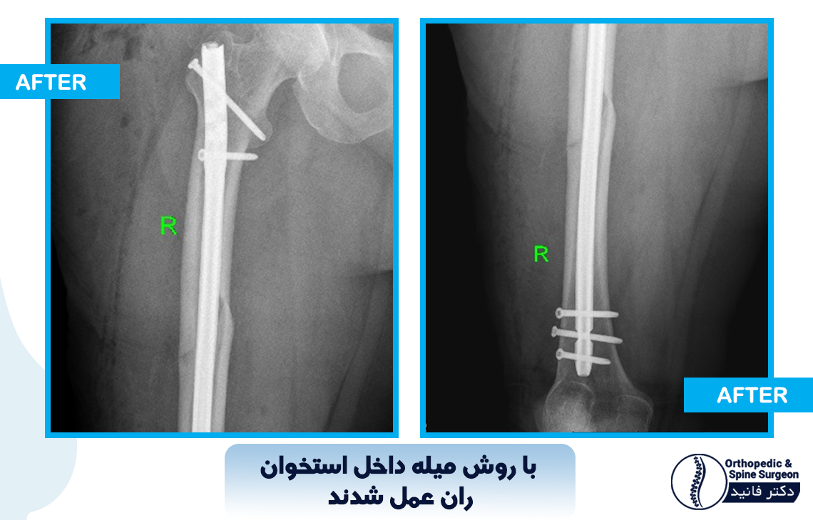 شکستگی مفصل ران 4